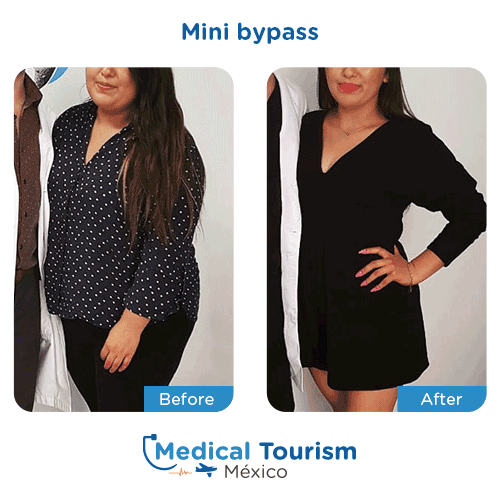 Patient before and after bariatric mini bypass