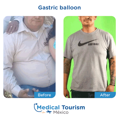 Patient before and after bariatric gastric balloon
