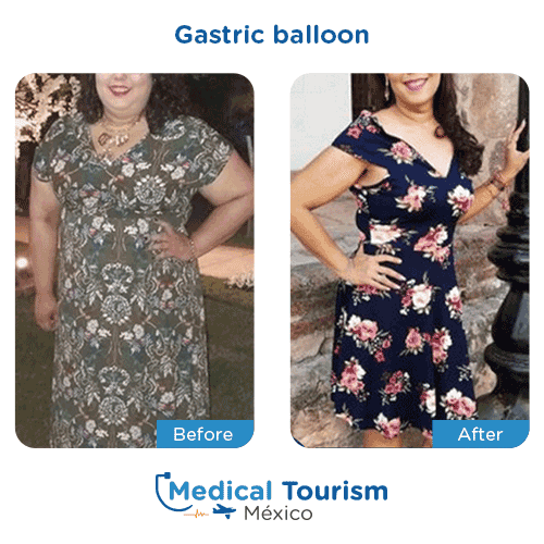 Patient before and after bariatric gastric balloon