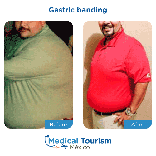 Patient before and after bariatric gastric band