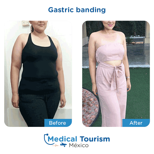 Patient before and after bariatric gastric band