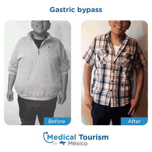 Patient before and after bariatric gastric bypass