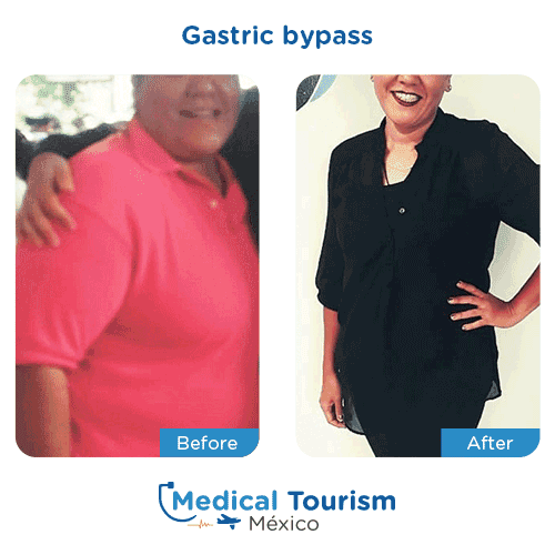 Patient before and after bariatric gastric bypass