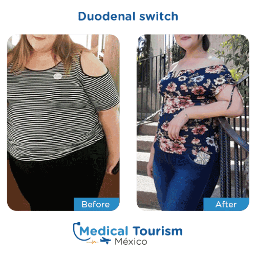 Patient before and after bariatric duodenal switch