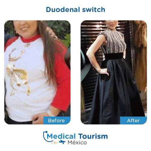 Patient before and after bariatric duodenal switch