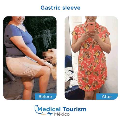 Patient before and after bariatric gastric sleeve