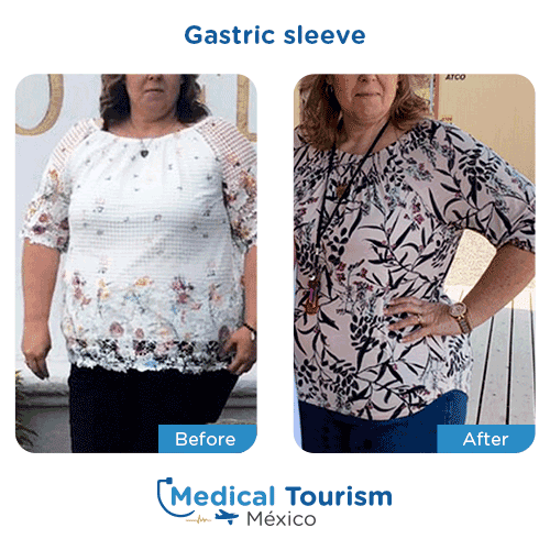Patient before and after bariatric gastric sleeve