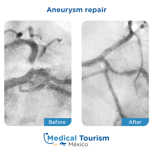 Illustrative image of Aneurysm repair