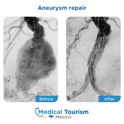 Illustrative image of Aneurysm repair