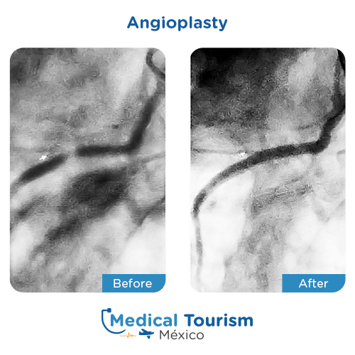 Illustrative image of Angioplasty