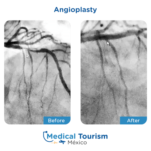 Illustrative image of Angioplasty