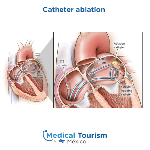 Illustrative image of Catheter ablation