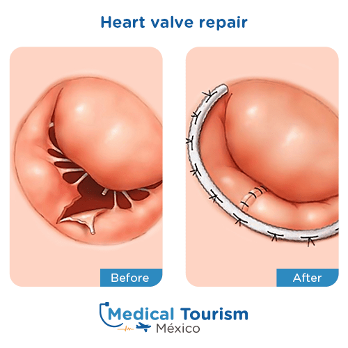 Illustrative image of Heart valve repair