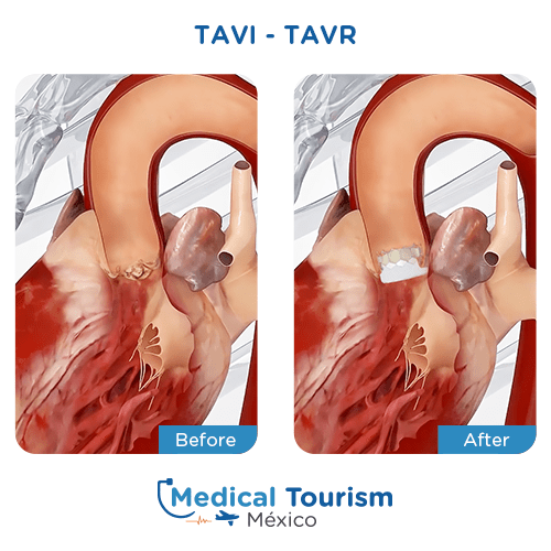 Illustrative image of TAVR