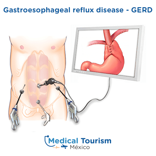 Illustrative image of a GERD surgery