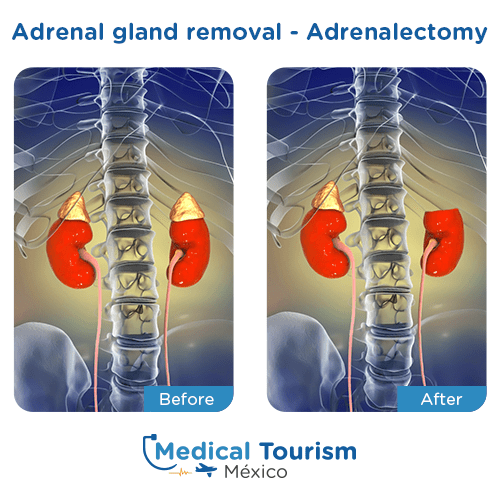 Illustrative image of a adrenal gland removal 