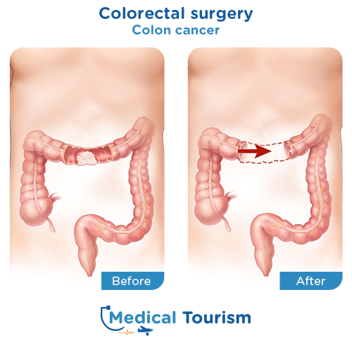 Illustrative image of a colorectal repair