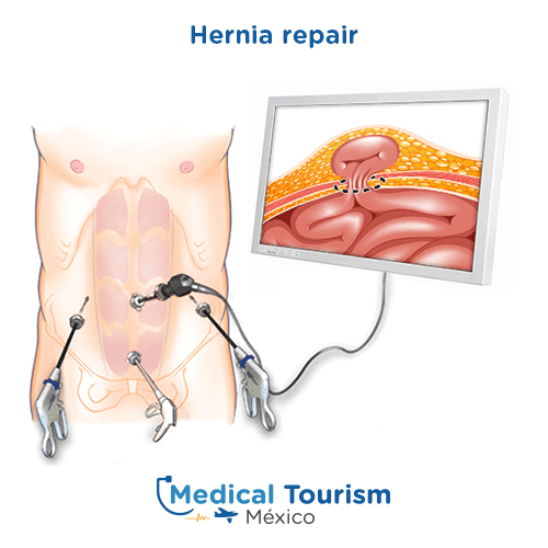 Illustrative image of a hernia repair