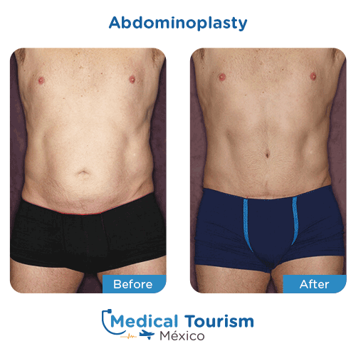 Patient before and after tummy tuck surgery