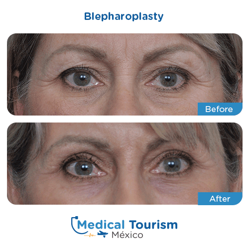 Patient before and after blepharoplasty surgery