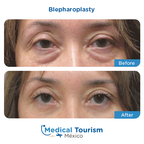 Patient before and after blepharoplasty surgery