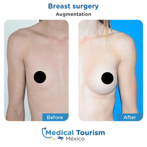 Patient before and after breast surgery