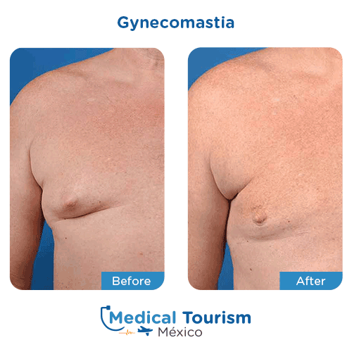 Patient before and after gynecomastia surgery