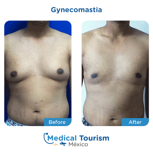 Patient before and after gynecomastia surgery