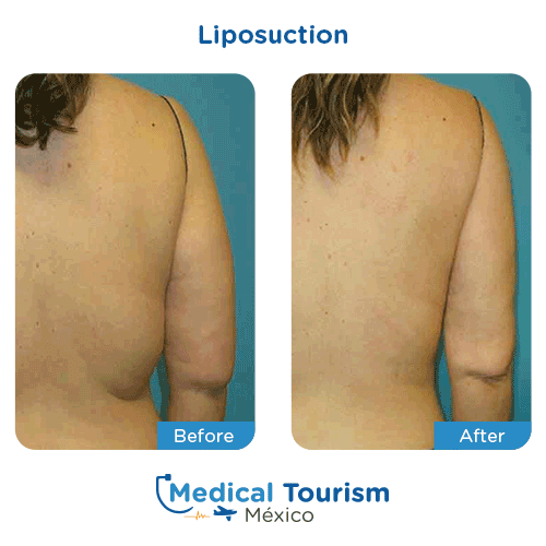 Patient before and after Liposuction