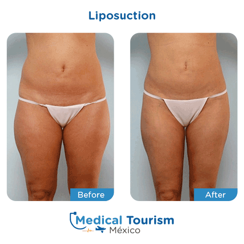 Patient before and after Liposuction
