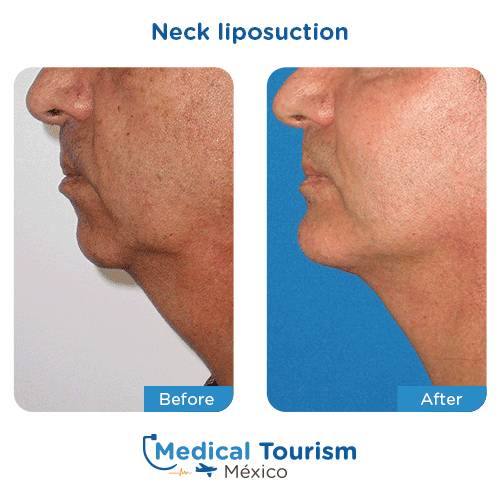 Patient before and after neck liposuction