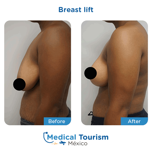 Patient before and after breast lift surgery