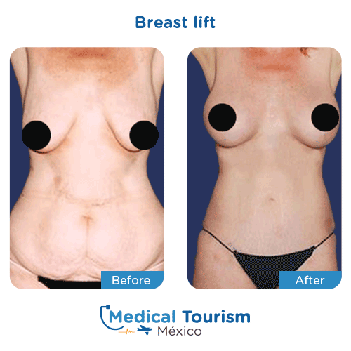 Patient before and after breast lift surgery