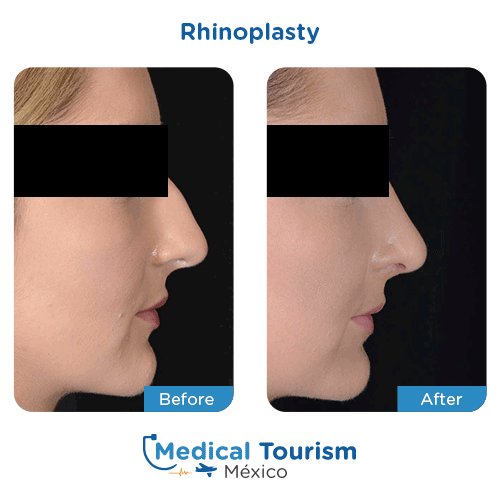 Patient before and after nose surgery