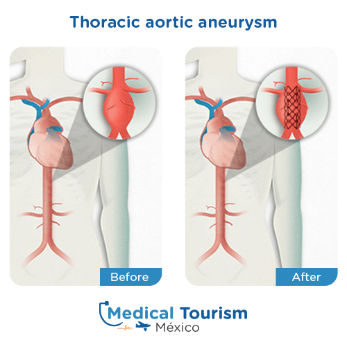 Illustrative image of Aortic aneurysm