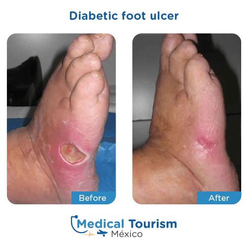 Illustrative image of Diabetic foot ulcers