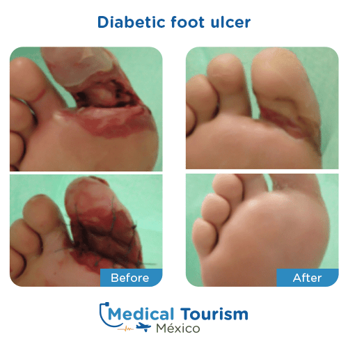 Illustrative image of Diabetic foot ulcers