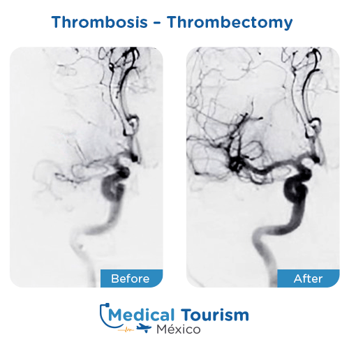 Illustrative image of Thrombosis