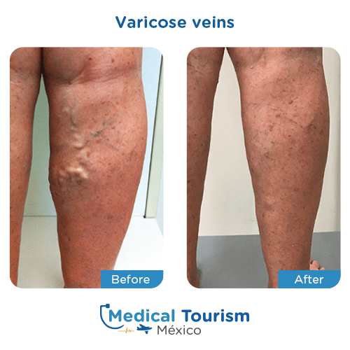 Illustrative image of Varicose veins