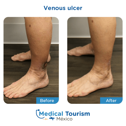 Illustrative image of Venous ulcer