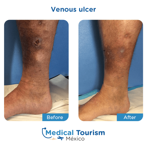 Illustrative image of Venous ulcer