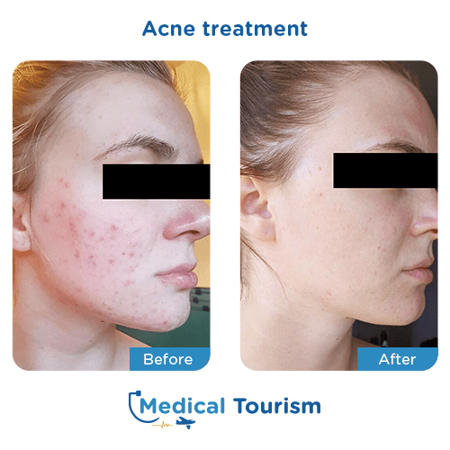 Illustrative image of Acne