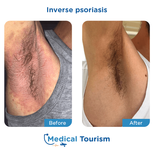 Illustrative image of Psoriasis