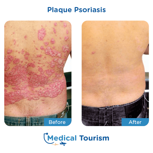 Illustrative image of Psoriasis