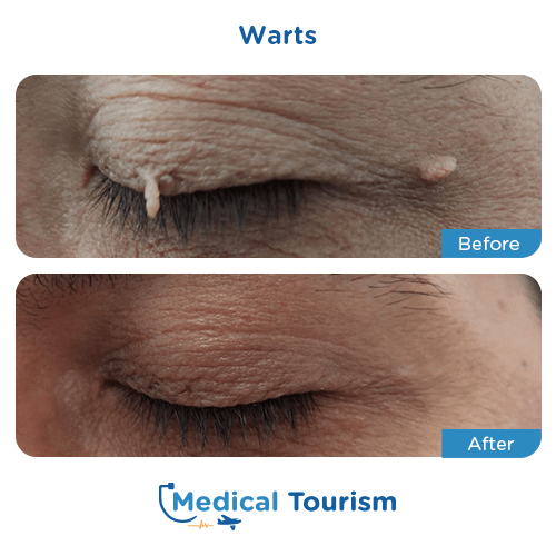 Illustrative image of Warts