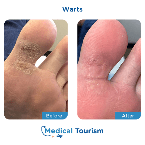 Illustrative image of Warts