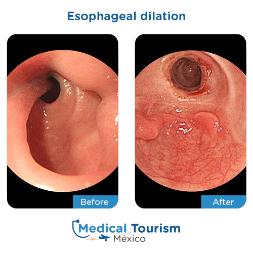 Before and after of Esophageal dilation 
