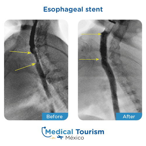 Before and after of Esophageal stent 