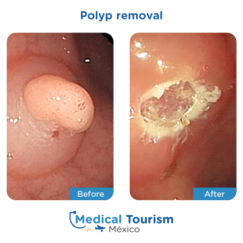 Illustrative image of Polyp removal