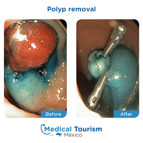 Illustrative image of Polyp removal